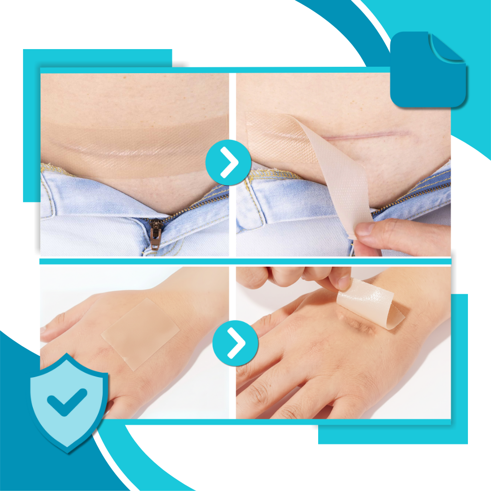 Hyaluronic Silicone Scar Patch - Ozerty